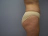 Brazilian Butt-lift