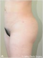  Brazilian Buttock Lift