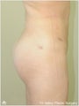  Brazilian Buttock Lift