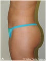 Brazilian Butt Lift
