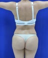 Brazilian Butt Lift