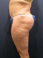 buttock fat grafting