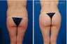 Brazilian Butt Lift