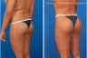 Brazilian Butt Lift