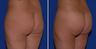 Brazilian Butt Lift