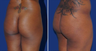 Brazilian Butt Lift