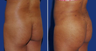 Brazilian Butt Lift