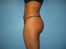 Brazilian Buttock lift (fat transfer to buttock)