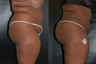 Brazilian Butt Lift