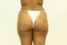 Brazilian Butt Lift