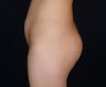 Brazilian Butt Lift