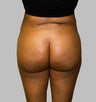 Brazilian Butt Lift