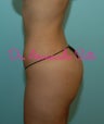 Brazilian Butt Lift
