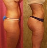 Brazilian buttock augmentation with fat grafting to the buttocks with liposuction in Los Angeles