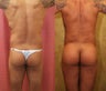 Brazilian buttock augmentation with fat grafting to the buttocks with liposuction in Los Angeles