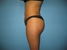 Brazilian Buttock Lift