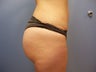 Brazilian Butt Lift