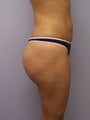 Brazilian Butt lift