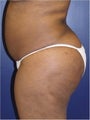 Brazilian Butt Lift