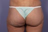 Brazillian Butt lift