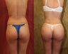 buttock augmentation