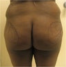 Brazilian Buttock Lift