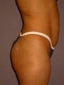 Fat Transfer, Brazilian Butt Lift