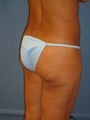 Brazilian Butt Lift