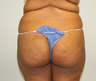 Brazilian butt lift