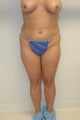 Brazilian butt lift