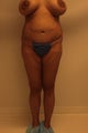 Brazilian butt lift