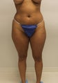  Brazilian butt lift