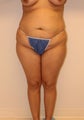 Brazilian butt lift