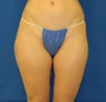Butt Lift