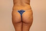 Brazilian butt lift