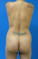 Brazilian Butt Lift