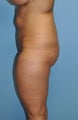 Buttock Augmentation with Fat Transfer (Brazilian Butt Lift)