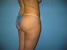 buttock augmentation (Brazilian buttock lift)