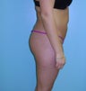 Brazilian Butt Lift