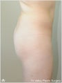  Brazilian Buttock Lift