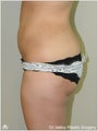  Brazilian Buttock Lift