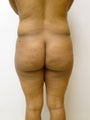 Brazilian Butt Lift
