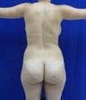 Brazilian Butt Lift