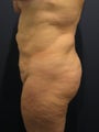 buttock fat grafting