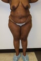 Brazilian Butt Lift