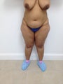Brazilian Butt Lift