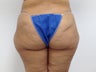 Brazilian Butt Lift