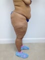 Brazilian Butt Lift
