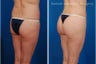 Brazilian Butt Lift