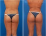 Brazilian Butt Lift